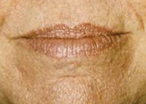 Antes